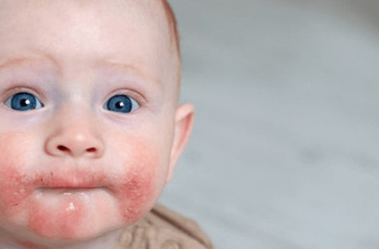 Atopik Dermatit Egzama