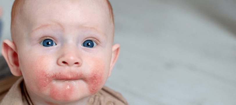 Atopik Dermatit Egzama